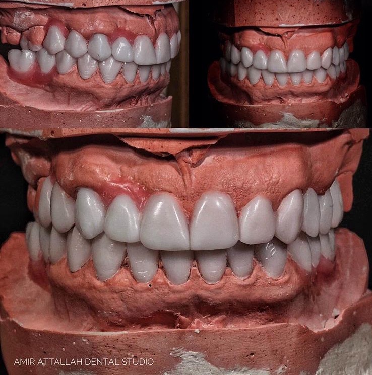 Wax mock-up style aesthetic case showing veneered teeth on mounted dental models