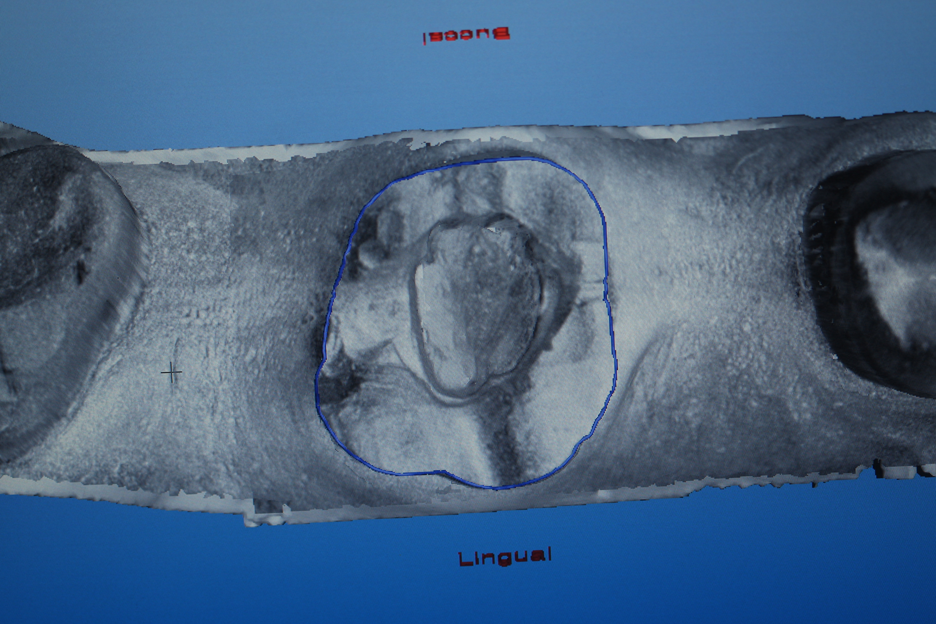 CAD-CAM diagram of a treated molar prepared for a crownlay restoration