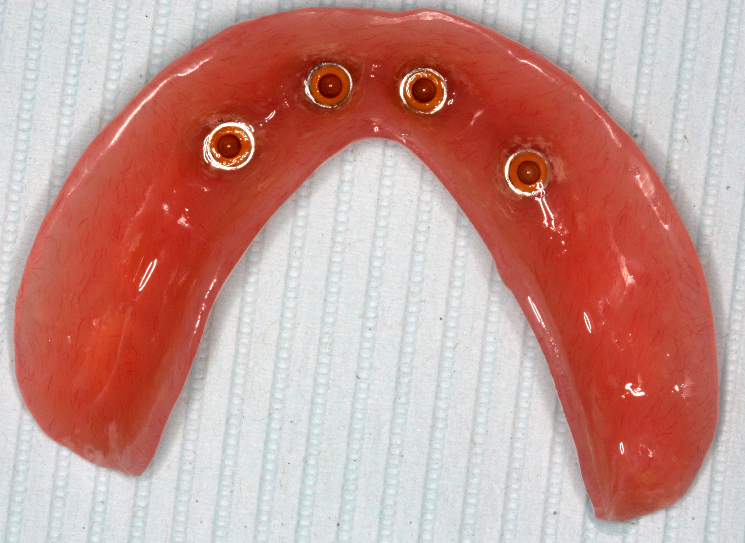 Full-arch implant overdenture with four implant attachment housings