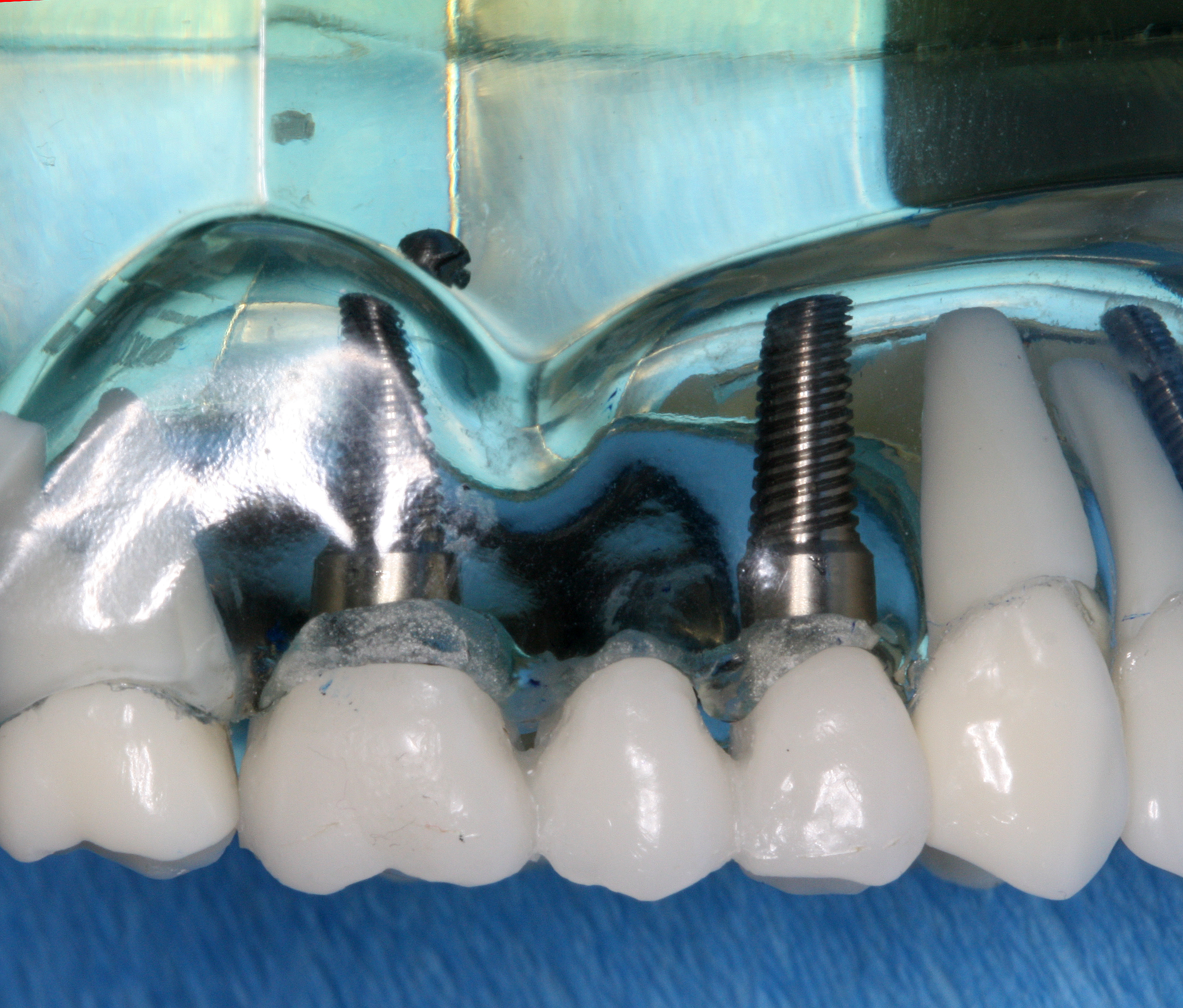 Implant-retained bridge model with visible implant abutments and prosthetic teeth